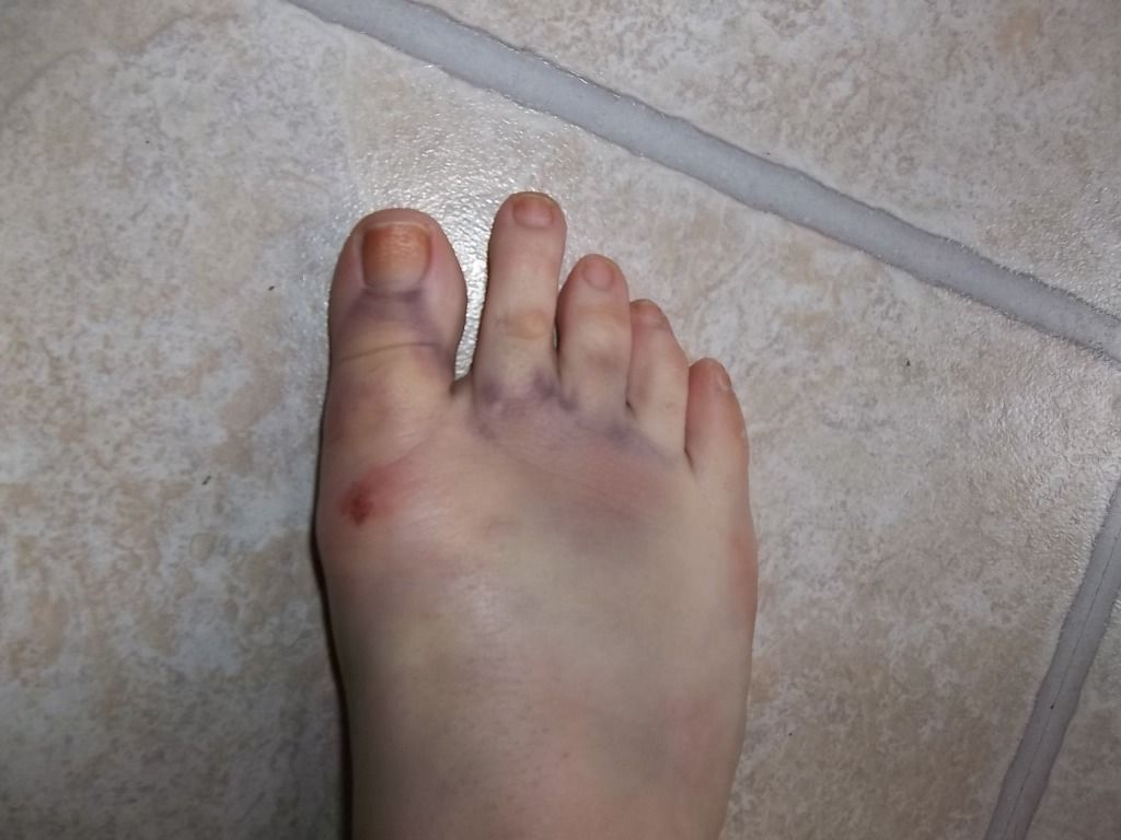 Carrie Candidly Old Wives Tales Pineapple for Bruises